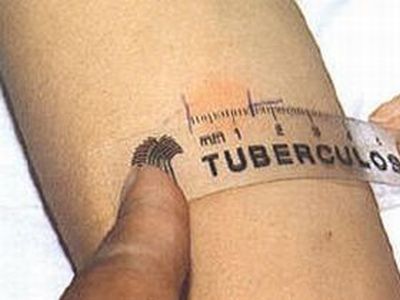 Туберкулез. Фото: scientific.ru